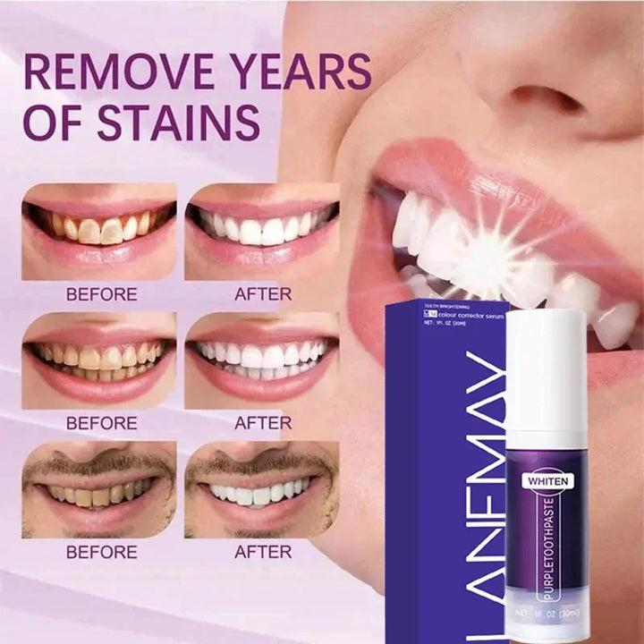 Teeth Whitening Kit
